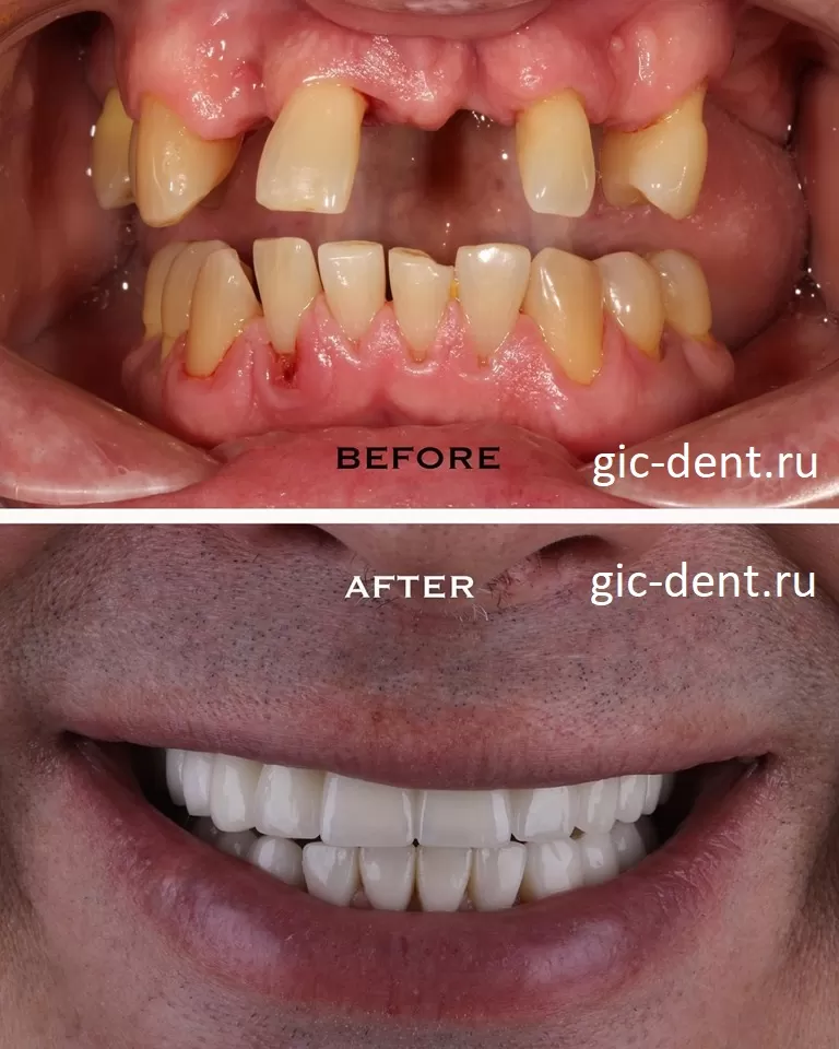 Пациенту всегда надо предлагать несколько вариантов решения эстетики зубов при имплантации и протезировании